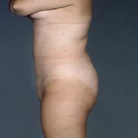 before after liposuction abdomen flanks