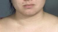 before after liposuction neck