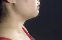 before after liposuction neck