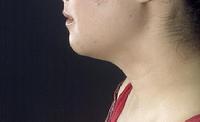 before after liposuction neck