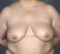 before after breast reduction