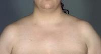before after liposuction neck