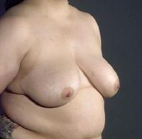 before after breast reduction