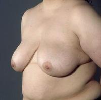 before after breast reduction