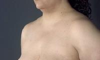 before after liposuction neck