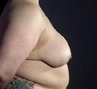 before after breast reduction