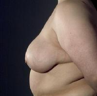 before after breast reduction