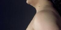 before after liposuction neck