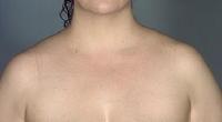 before after liposuction neck