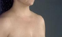 before after liposuction neck