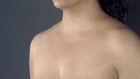 before after liposuction neck