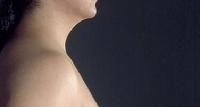 before after liposuction neck