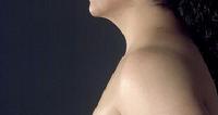 before after liposuction neck