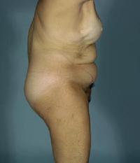 before after tummy tuck abdominoplasty