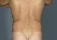 before after liposuction male abdomen flanks