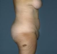 before after liposuction abdomen flanks