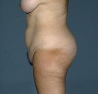 before after liposuction abdomen flanks