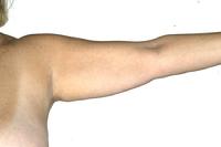 before after liposuction arms