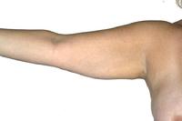 before after liposuction arms