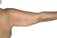 before after liposuction arms