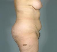 before after liposuction abdomen/flanks