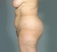 before after liposuction abdomen/flanks