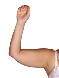 before after liposuction arms