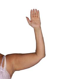 before after liposuction arms