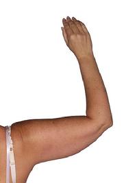 before after liposuction arms