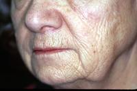 before after TCA peel