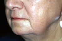 before after TCA peel