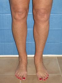 cankles