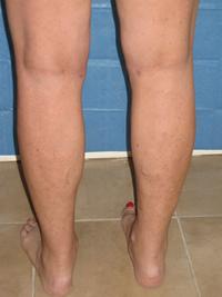 cankles