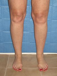 cankles