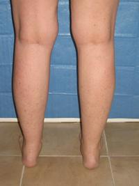 cankles