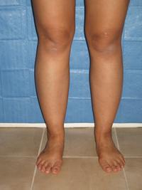 cankles