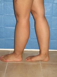 cankles