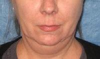 before/after liposuction neck