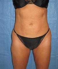 before after liposuction abdomen flanks