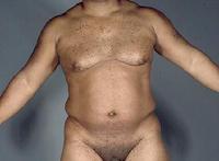 before after liposuction male chest abdomen flanks