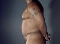 before after liposuction male chest abdomen flanks
