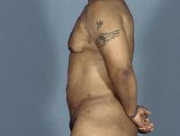 before after liposuction male chest abdomen flanks