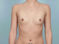 before after breast augmentation
