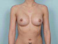 before after breast augmentation
