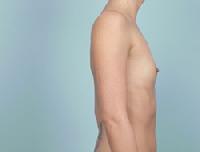 before after breast augmentation