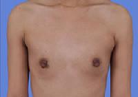 before after breast augmentation