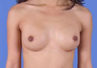 before after breast augmentation