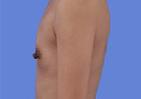 before after breast augmentation