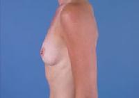 before after breast augmentation