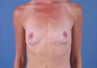 before after breast augmentation